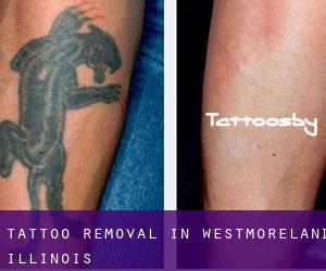 Tattoo Removal in Westmoreland (Illinois)