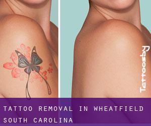 Tattoo Removal in Wheatfield (South Carolina)