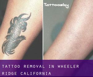 Tattoo Removal in Wheeler Ridge (California)