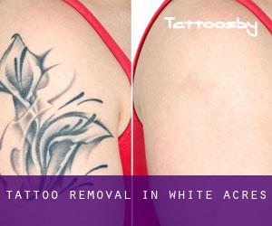 Tattoo Removal in White Acres