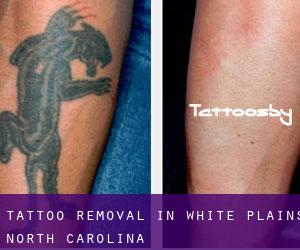 Tattoo Removal in White Plains (North Carolina)