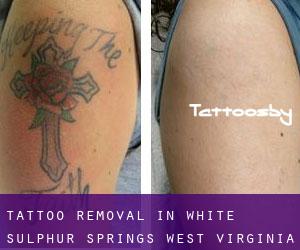 Tattoo Removal in White Sulphur Springs (West Virginia)