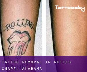 Tattoo Removal in Whites Chapel (Alabama)