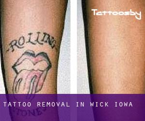Tattoo Removal in Wick (Iowa)