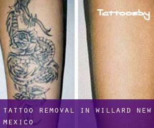 Tattoo Removal in Willard (New Mexico)
