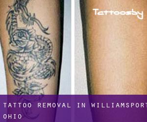 Tattoo Removal in Williamsport (Ohio)