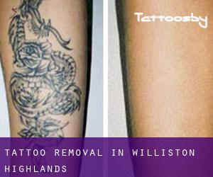 Tattoo Removal in Williston Highlands