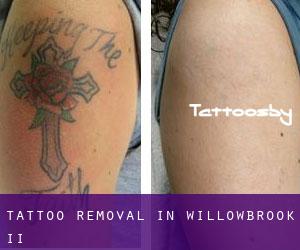 Tattoo Removal in WillowBrook II