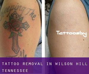 Tattoo Removal in Wilson Hill (Tennessee)