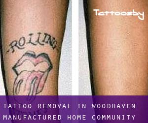 Tattoo Removal in Woodhaven Manufactured Home Community