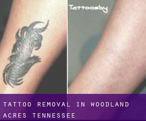 Tattoo Removal in Woodland Acres (Tennessee)