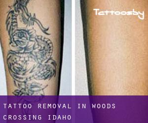 Tattoo Removal in Woods Crossing (Idaho)