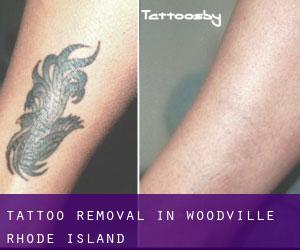 Tattoo Removal in Woodville (Rhode Island)