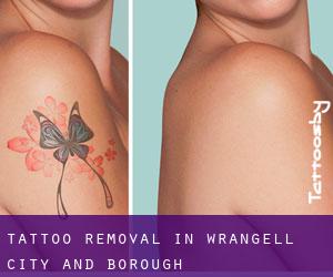 Tattoo Removal in Wrangell (City and Borough)