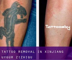 Tattoo Removal in Xinjiang Uygur Zizhiqu