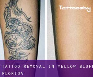 Tattoo Removal in Yellow Bluff (Florida)