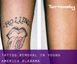 Tattoo Removal in Young America (Alabama)